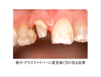 術中・グラスファイバーに変更 歯ぐきの色も改善