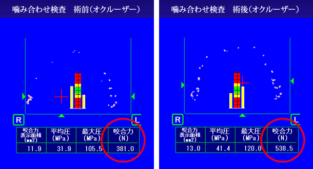 オクルーザー術前・術後