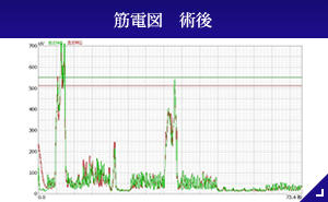 筋電図　術後