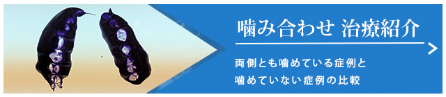 噛み合わせ 治療紹介