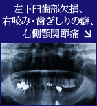 左下臼歯部欠損、右咬み・歯ぎしりの癖、右側顎関節痛