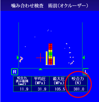 術前：噛み合わせのバランスが悪い状態