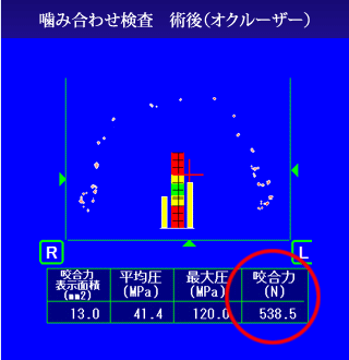 術後：咬合調整により、左右のバランスが取れた状態