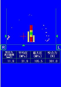 咬合力の増加